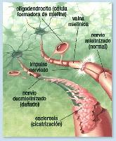 Esclerosis